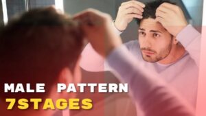Male Pattern Baldness stages