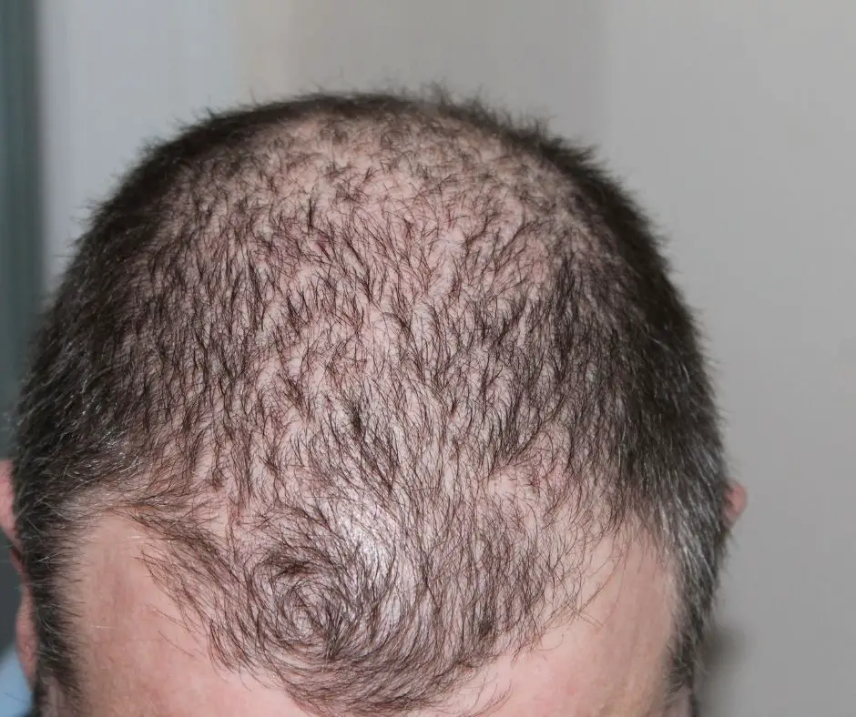How to Tell if You're Balding