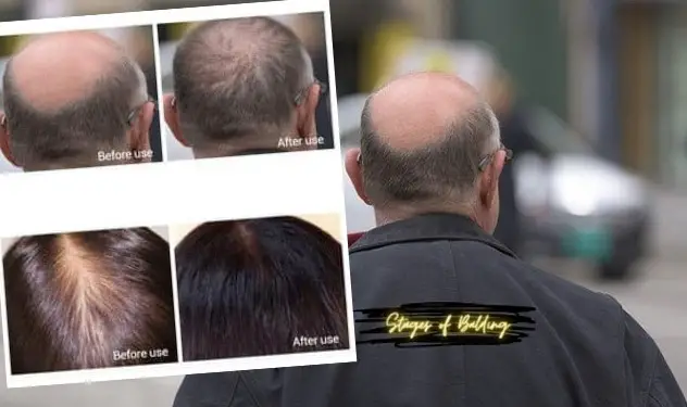 Stages of Balding