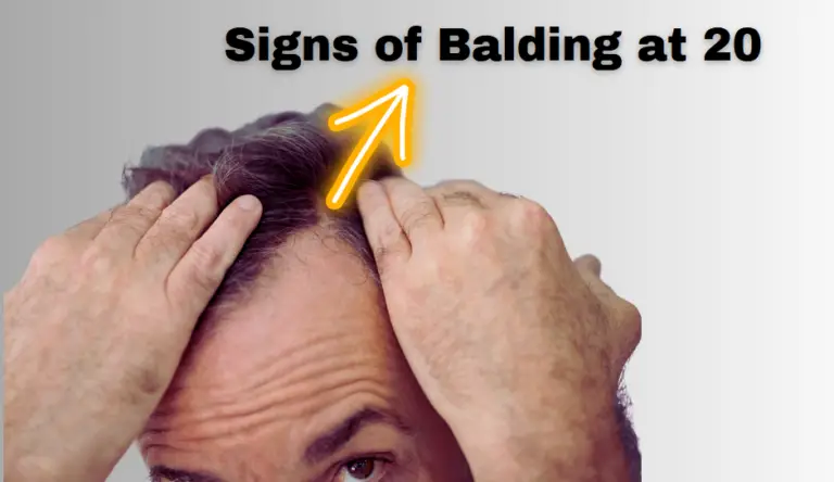 Signs of Balding at 20