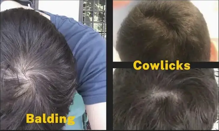 cowlick vs balding