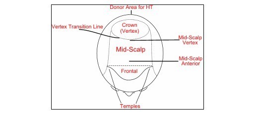 Norwood Scale Types of Receding Hairlines
