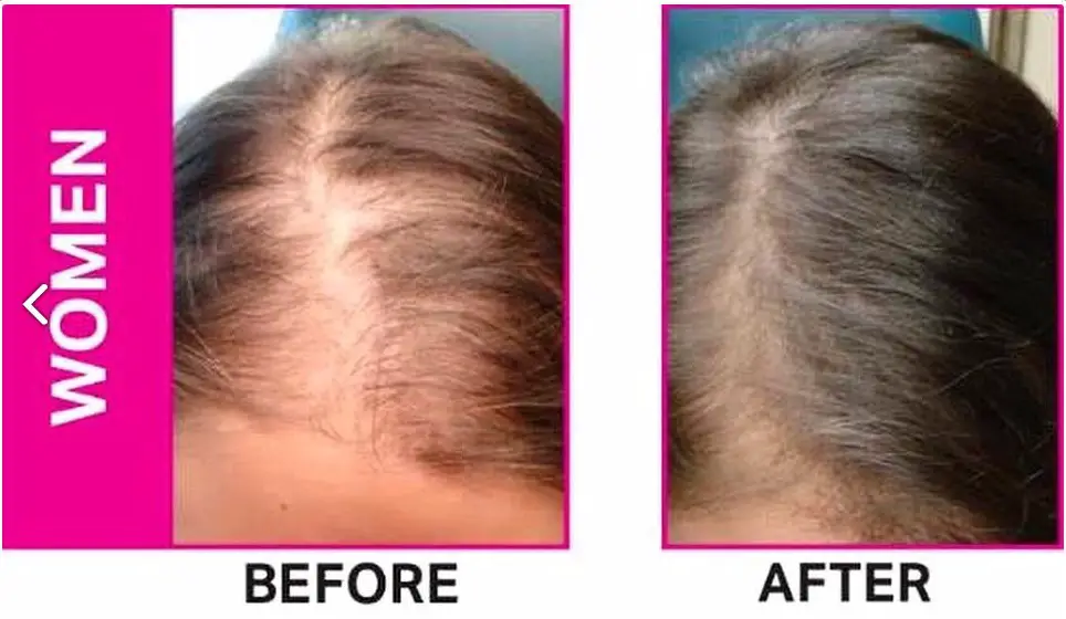 Female Pattern Baldness Pictures before and after