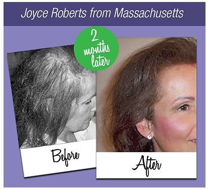Hair Rejuvenation Before and After
