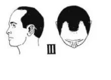 Norwood Scale 3 Male Pattern Baldness Stages