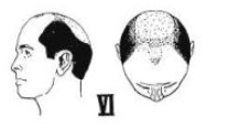 Norwood Scale 6 Male Pattern Baldness Stages