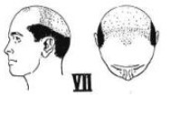 Norwood Scale 7 Male Pattern Baldness Stages