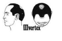 Male Pattern Baldness Stages 3 Vertex