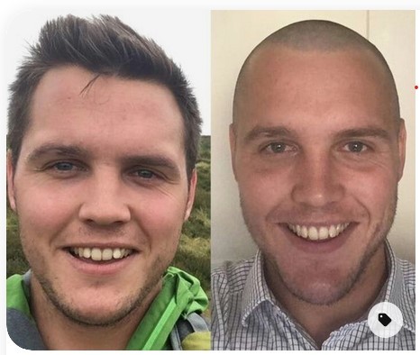 buzz cut balding before and after