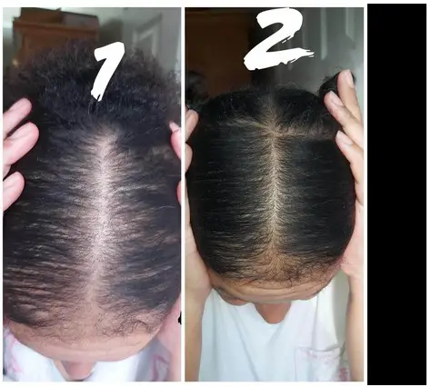 Female Pattern Hair Loss Success Stories 2021