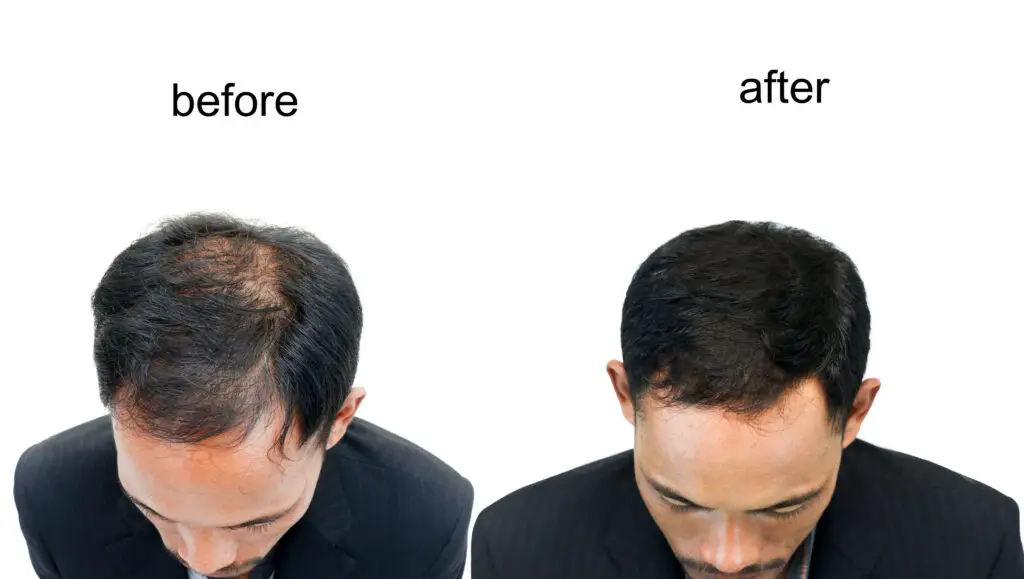 alternative to hair transplant