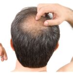 What Causes Balding