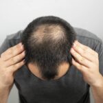 male pattern baldness cure