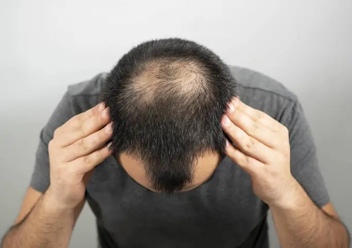 male pattern baldness cure