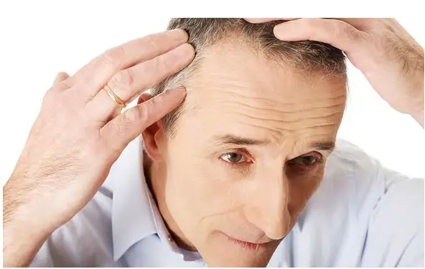 Can Androgenic Alopecia Be Reversed