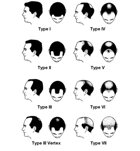 Stages of Male Pattern Baldness on the Norwood Hamilton scale