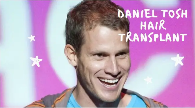 Daniel Tosh hair transplant