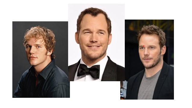 Chris pratt before and after hair transplant