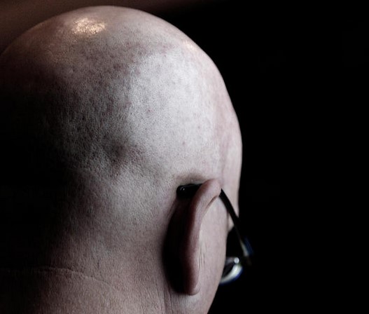 How to go Bald Permanently