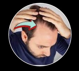 thinning crown bald spot