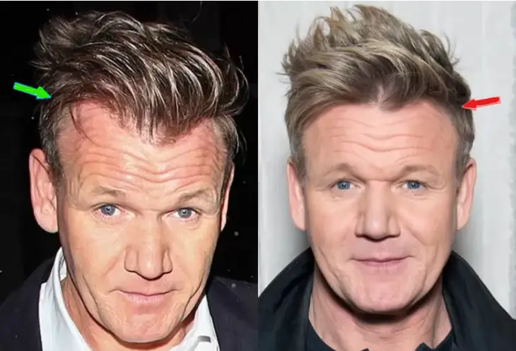 Gordon Ramsay Before and After Hair Transplant