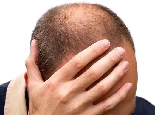 The Big 3 Hair Loss treatment
