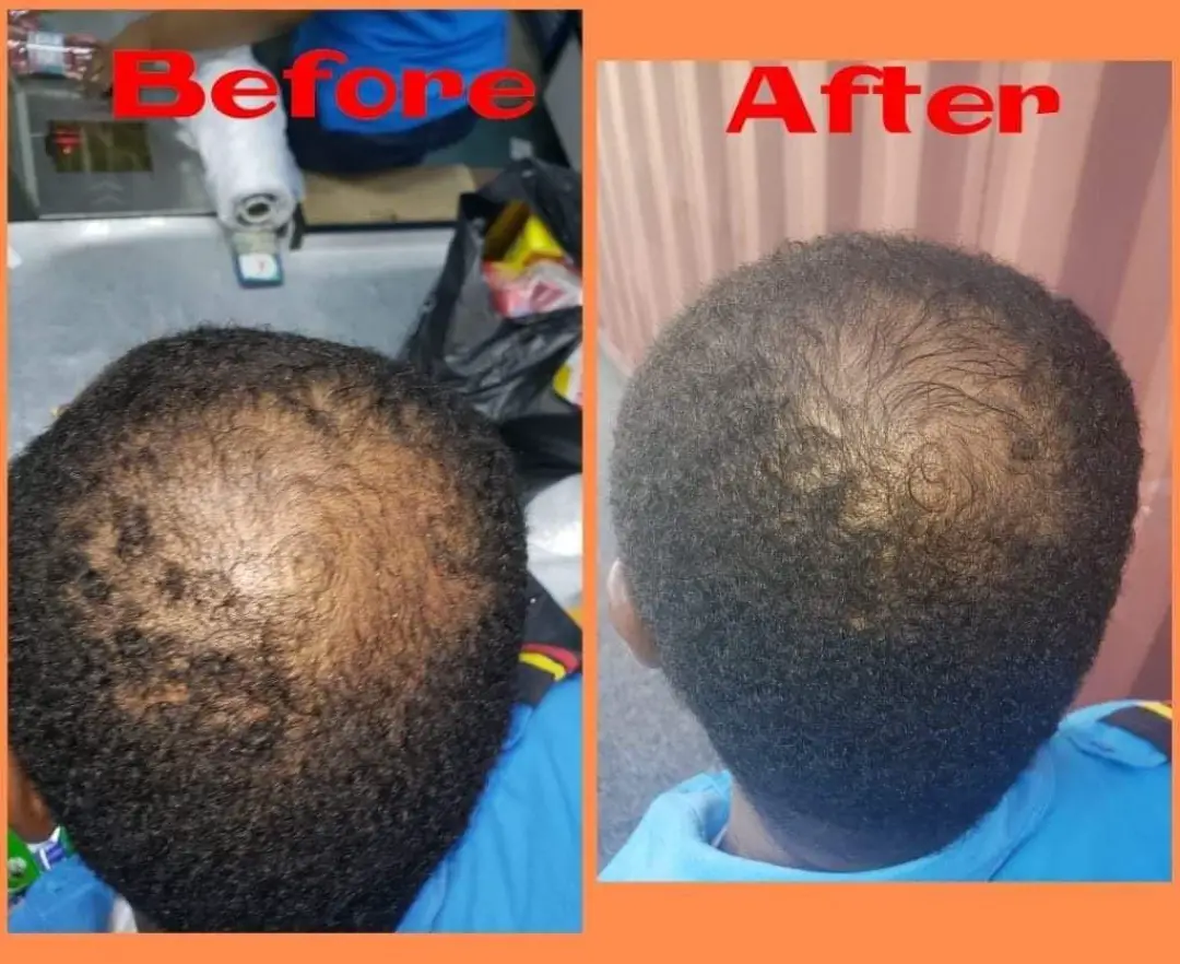 big 3 hair loss before and after