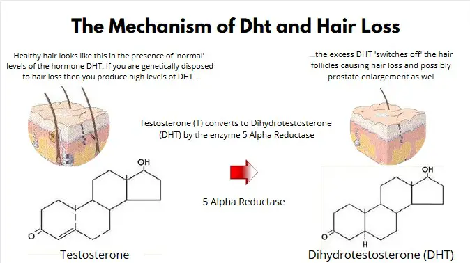 Dht and Hair Loss