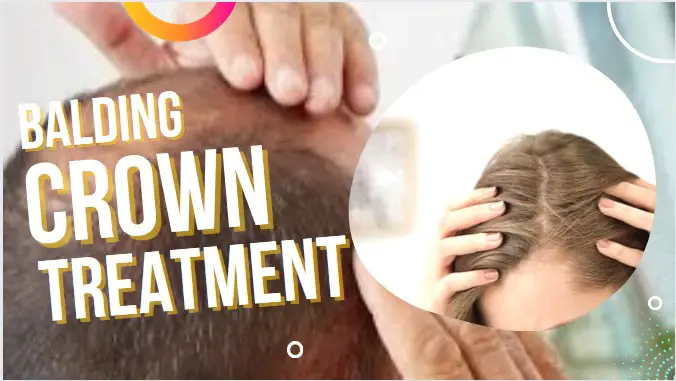 How to Stop Balding at The Crown