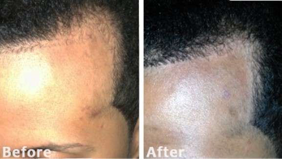 Low Level Laser Light Therapy For Hair Loss