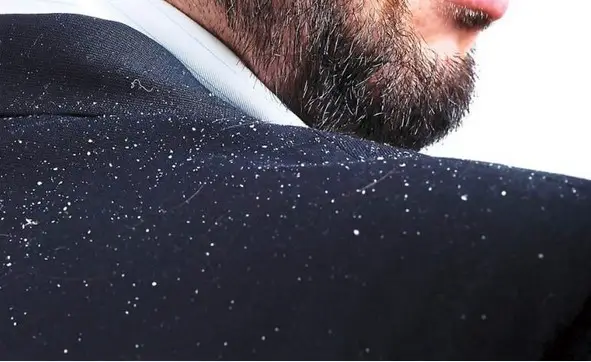 what causes dandruff in hair