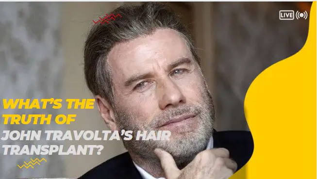 John Travolta hair transplant