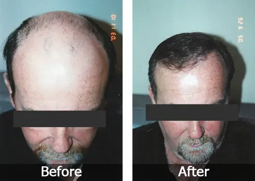 Retrograde Alopecia