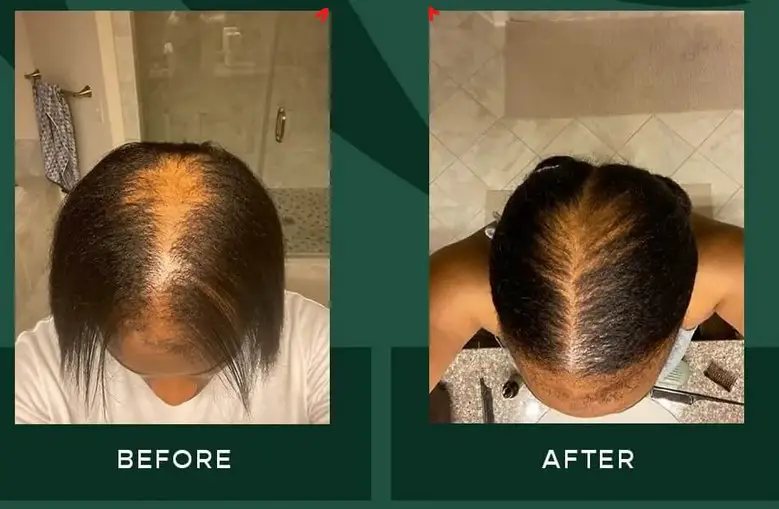 red light therapy for hair loss before and after
