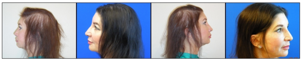 Female pattern hair loss before and after LLLT treatment