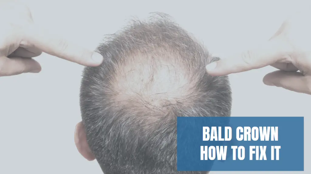 Bald Crown How To Fix It When Spot It Stages Of Balding