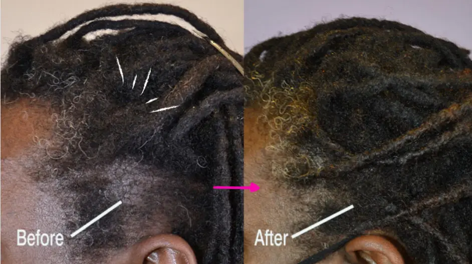 How Hair Extensions Cause Traction Alopecia