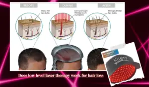 Low Level Light Therapy for Hair Loss