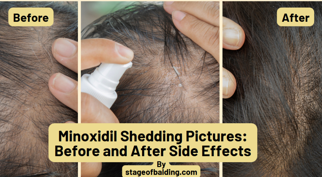 Minoxidil Shedding Pictures