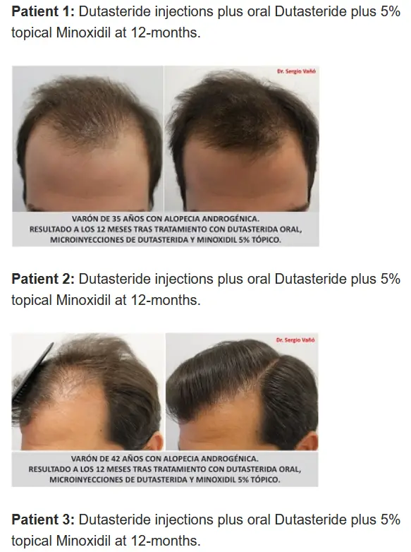 Topical dutasteride before and after