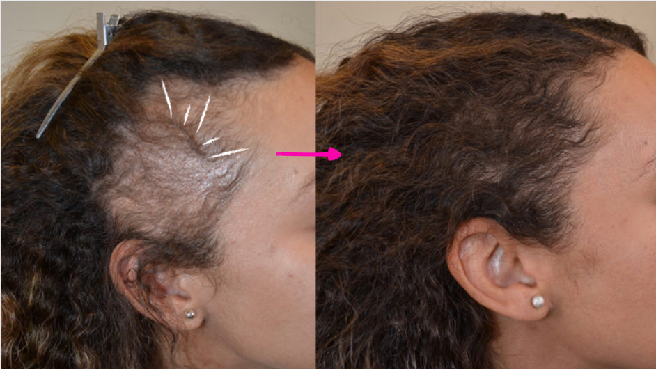 Traction Alopecia Hair Transplant