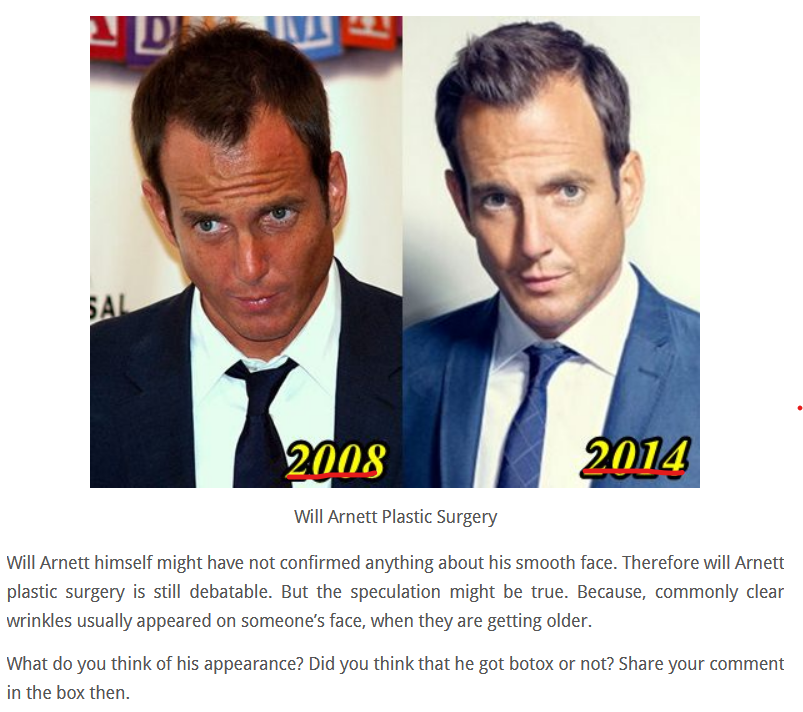 Will Arnett hair transplant Before and After