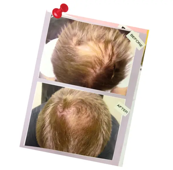 does low level laser therapy work for hair loss