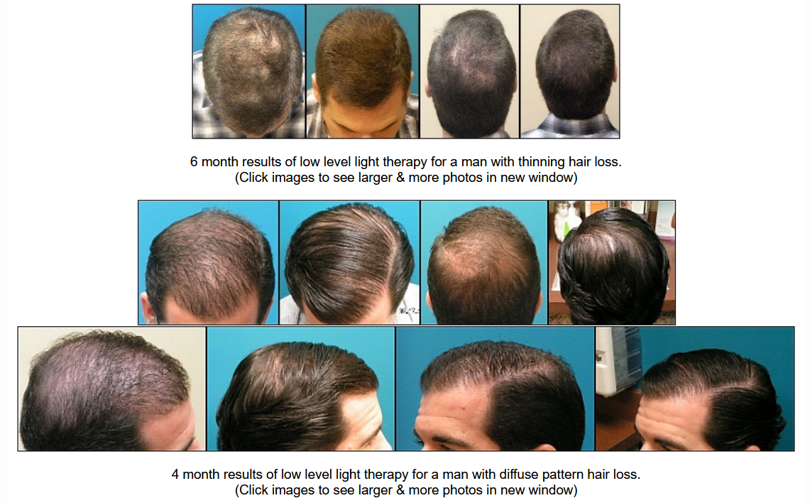 Male with pattern hair loss before and after LLLT treatment