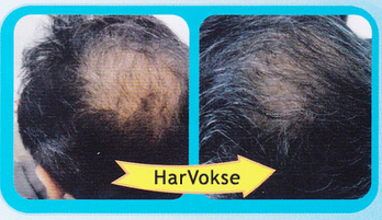 Har Vokse before and after