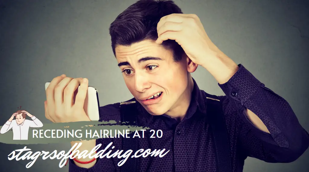 receding hairline at 20