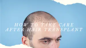 How to take care after hair transplant