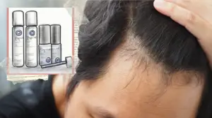 Minoxidil for Receding Hairline