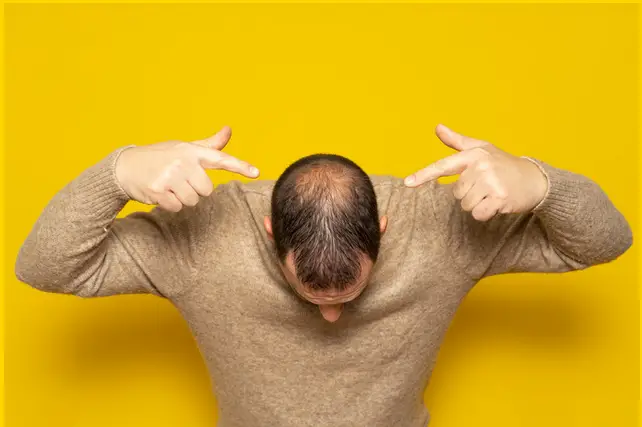 male hair loss stages