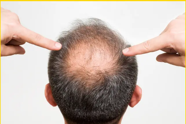 stage 4 hair loss